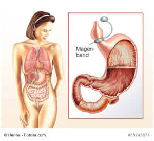 Magenband, Übergewicht, Ernährung, Essgewohnheiten, Magen-Darm, Verdauung